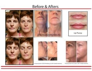 نتیجه فیلرینا