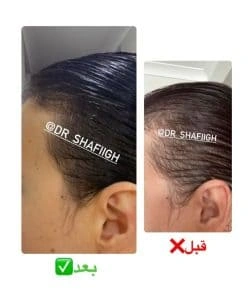 نتیجه استفاده از سرم ریزش، رویش و افزایش ضخامت مو کرشینا برای آقایان