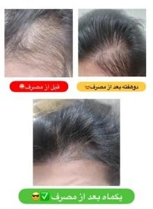 نتیجه سرم ریزش، رویش و افزایش ضخامت مو کرشینا برای آقایان